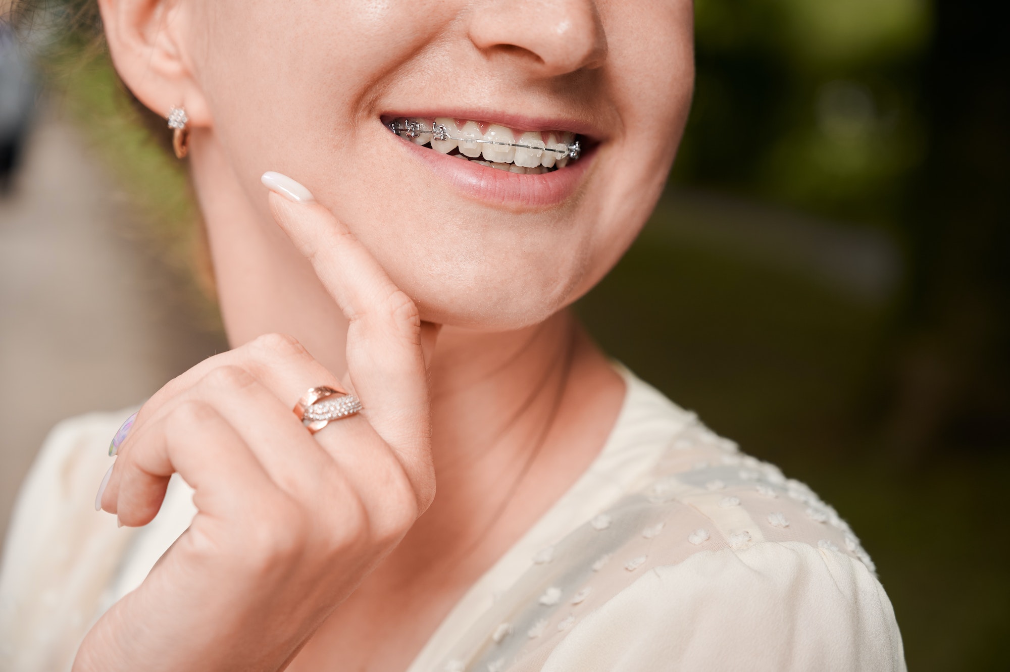 Female smile with orthodontic braces on teeth.